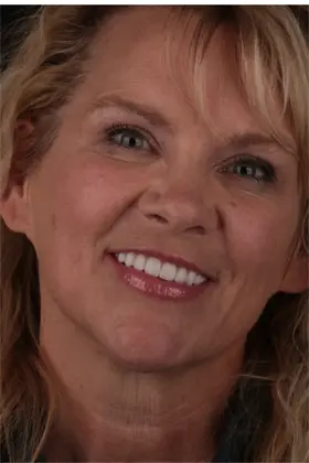 Wide and happy smile after successful gum contouring with porcelain veneers.